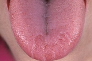 Närbild av en rödaktig tunga med ojämna områden och små upphöjningar.