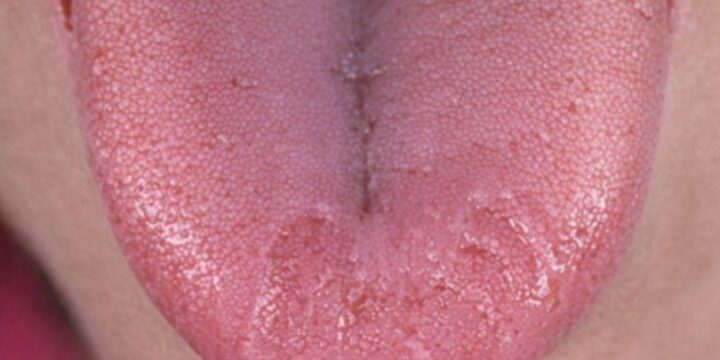 Bränner det i munnen? Så hanterar du munsveda (BMS)